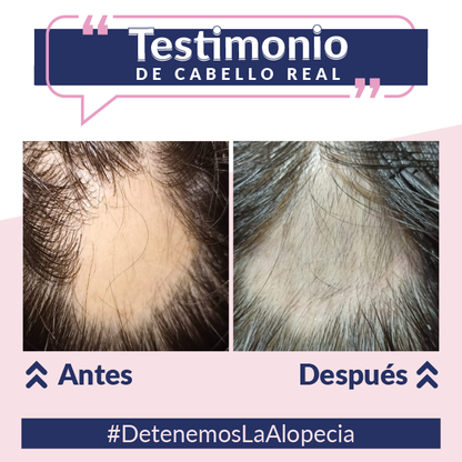 Loción capilar con Minoxidil + Shampoo Anti-Caída + Tratamiento Nutritivo - 40%