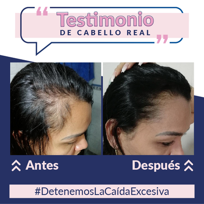 Loción capilar con Minoxidil + Shampoo Anti-Caída + Tratamiento Nutritivo - 40%