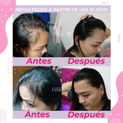 Loción capilar con Minoxidil + Shampoo Anti-Caída + Tratamiento Nutritivo - 40%